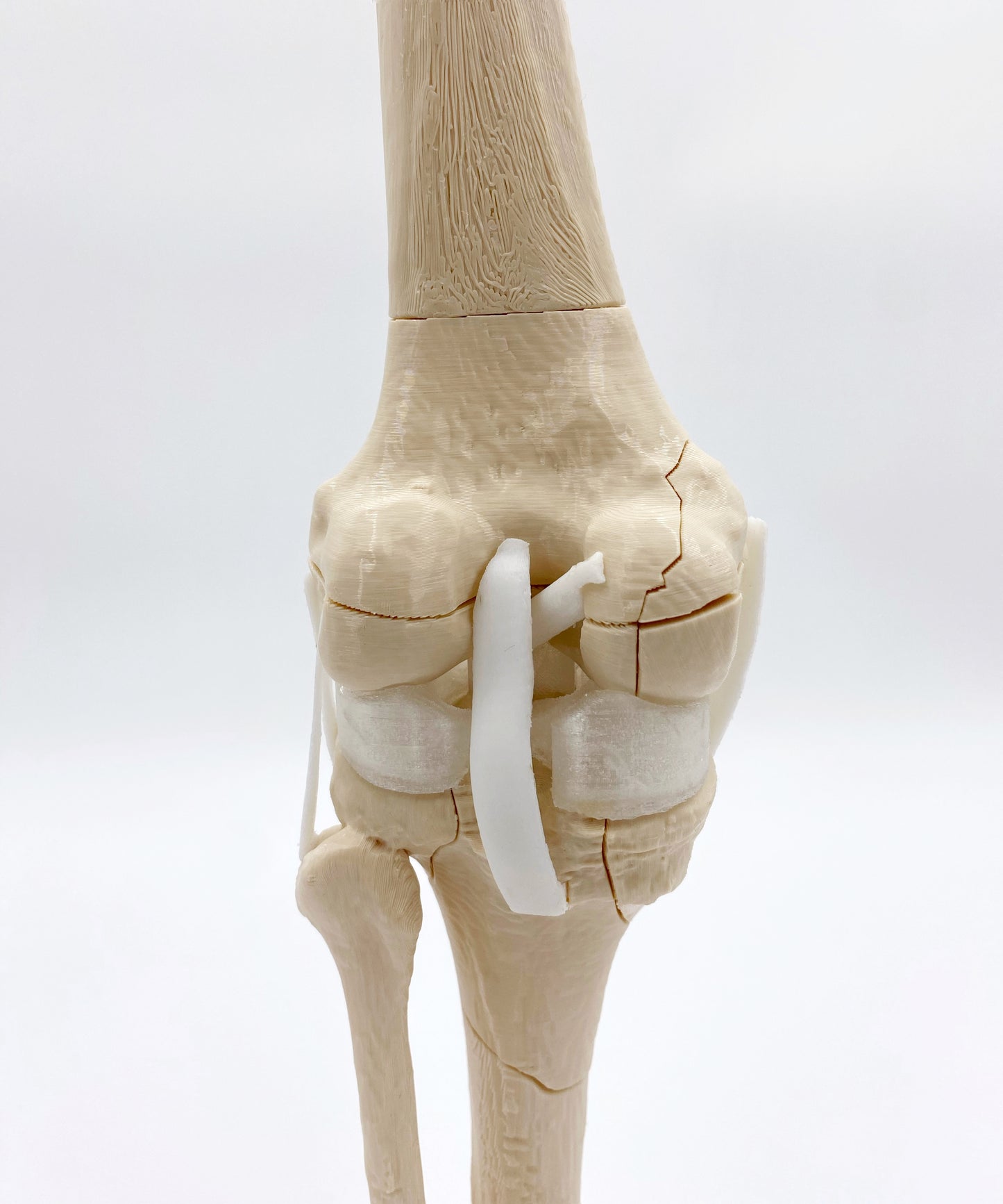 Modelo de Rodilla Fracturas