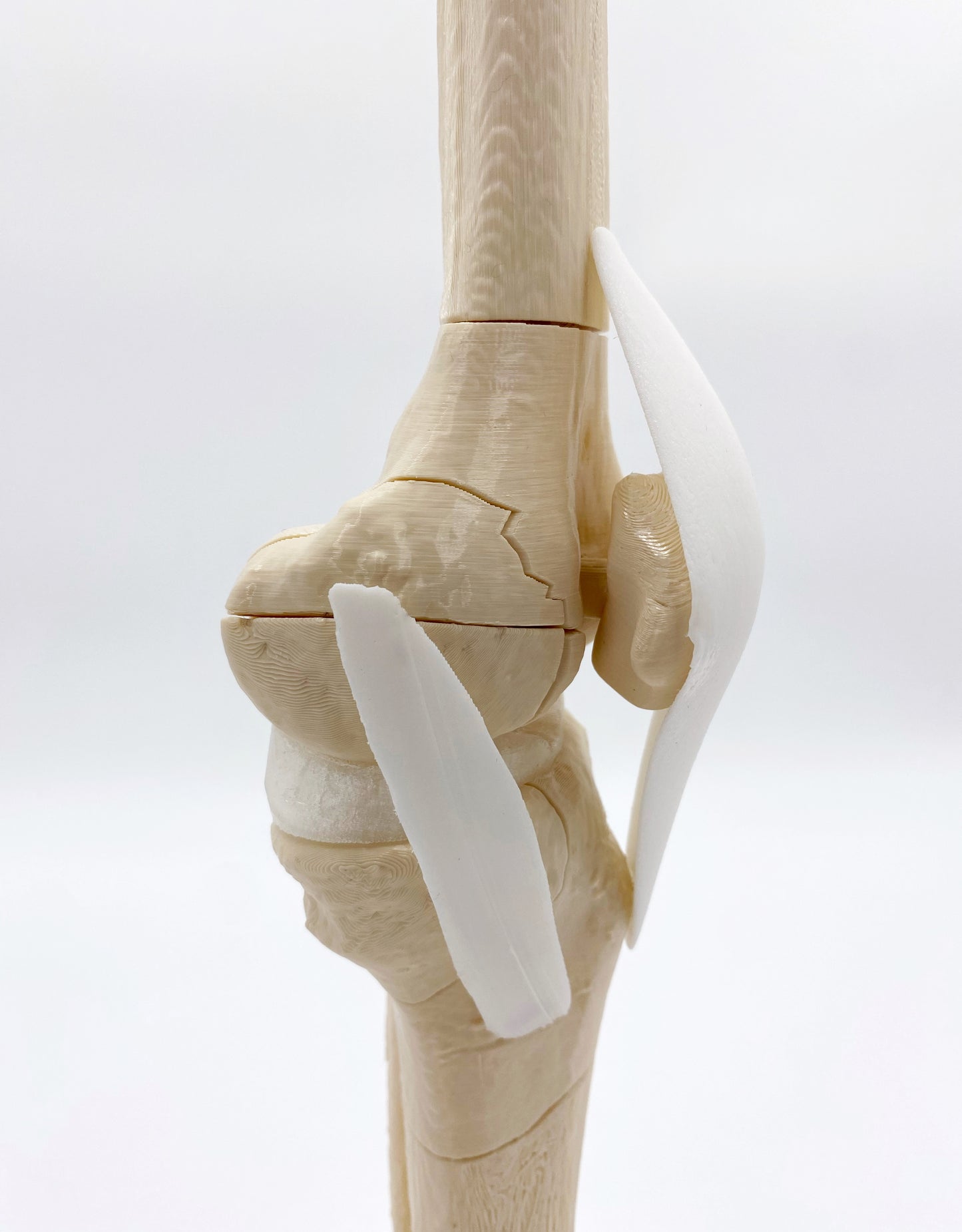 Modelo de Rodilla Fracturas